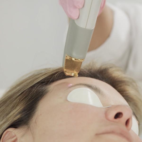 woman receiving facial laser treatment