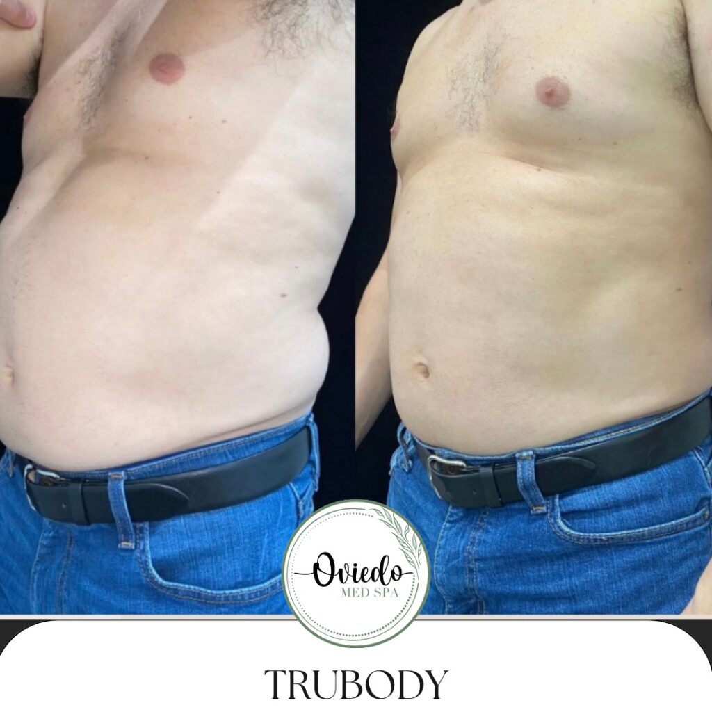 truflex before and after of man's abs