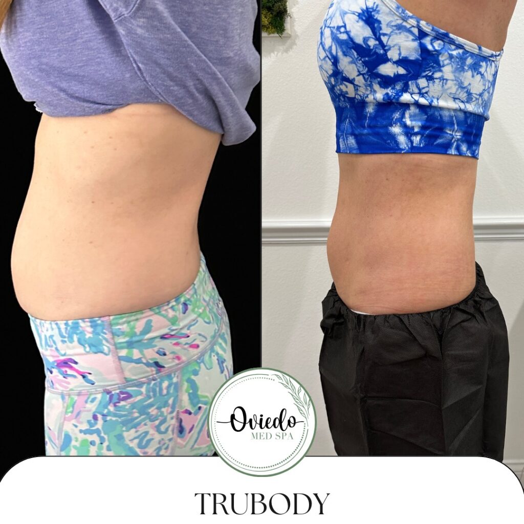 truflex before and after woman's abs